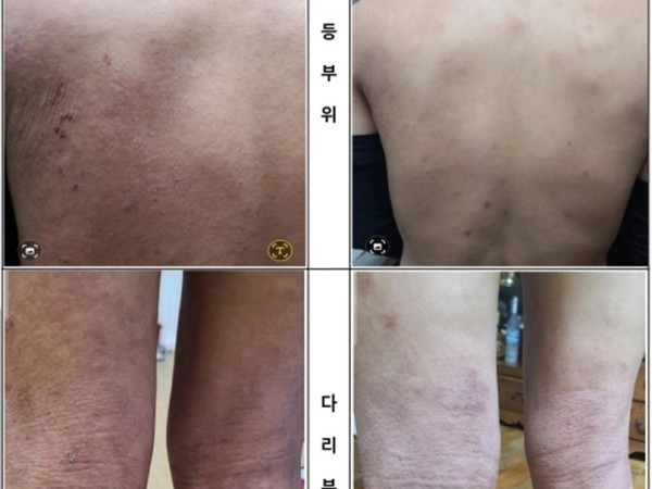 일상 속 외부 자극으로 지친 등 및 다리 부위, 15일간의 집중 웰니스 컨디션 케어 기록